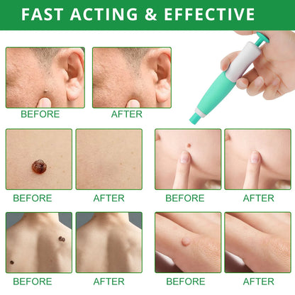 Band Painless Mole Wart Skin Tag Remover